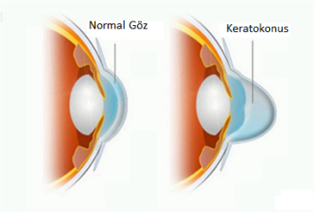 Keratoconus